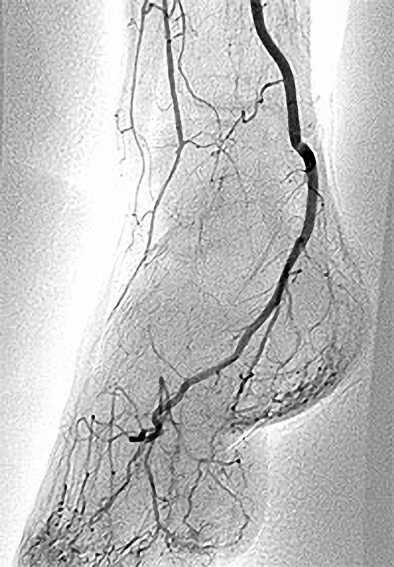 Röntgen-Angiografie -  Arterien des Fußes